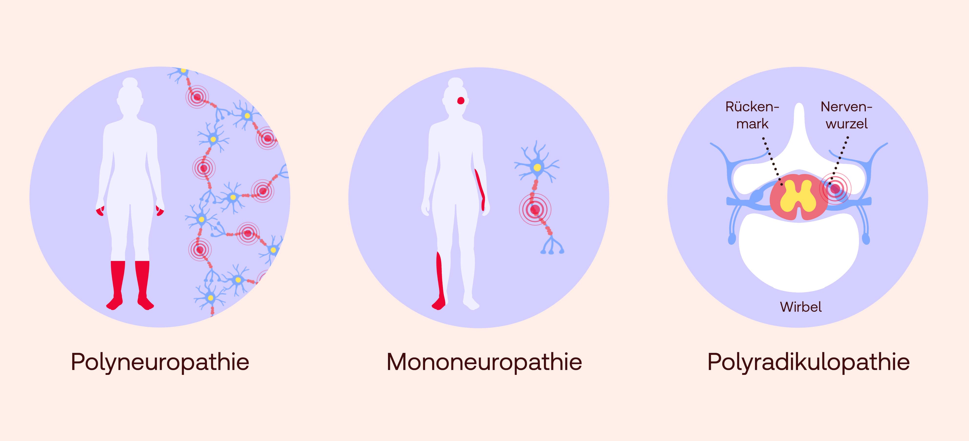 Polyneuropathie Symptome Behandlung Shop Apotheke