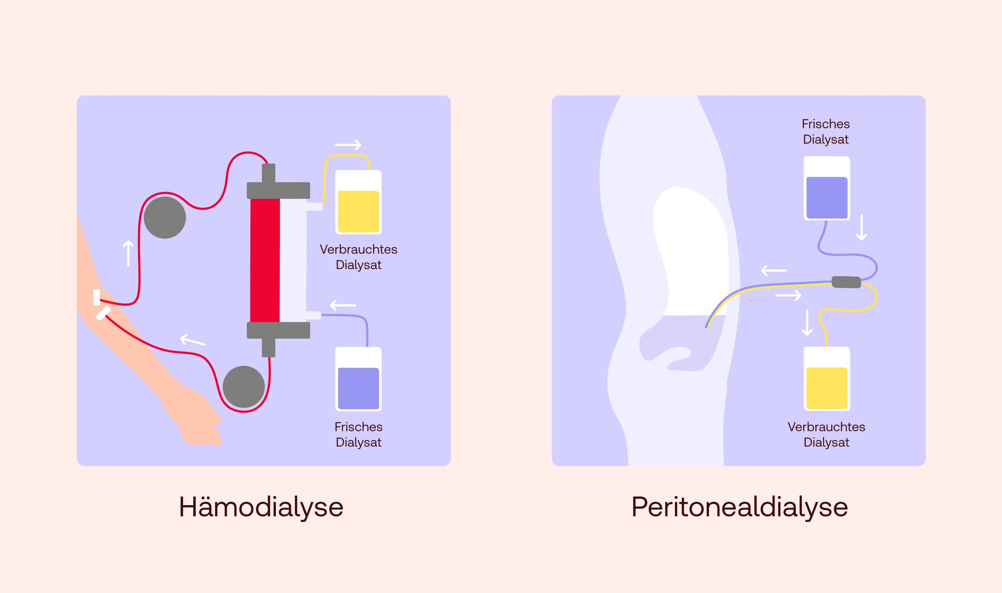 Dialyse Techniken