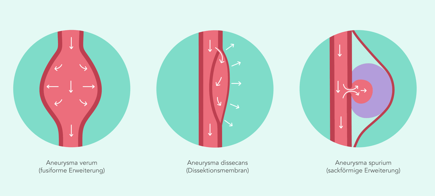 3 Hauptformen der Aneurysmen