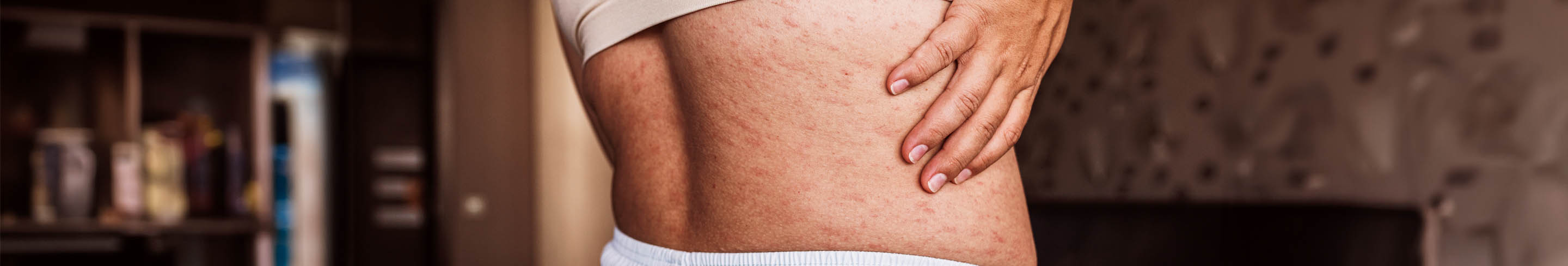 Kleienpilzflechte Ratgeber