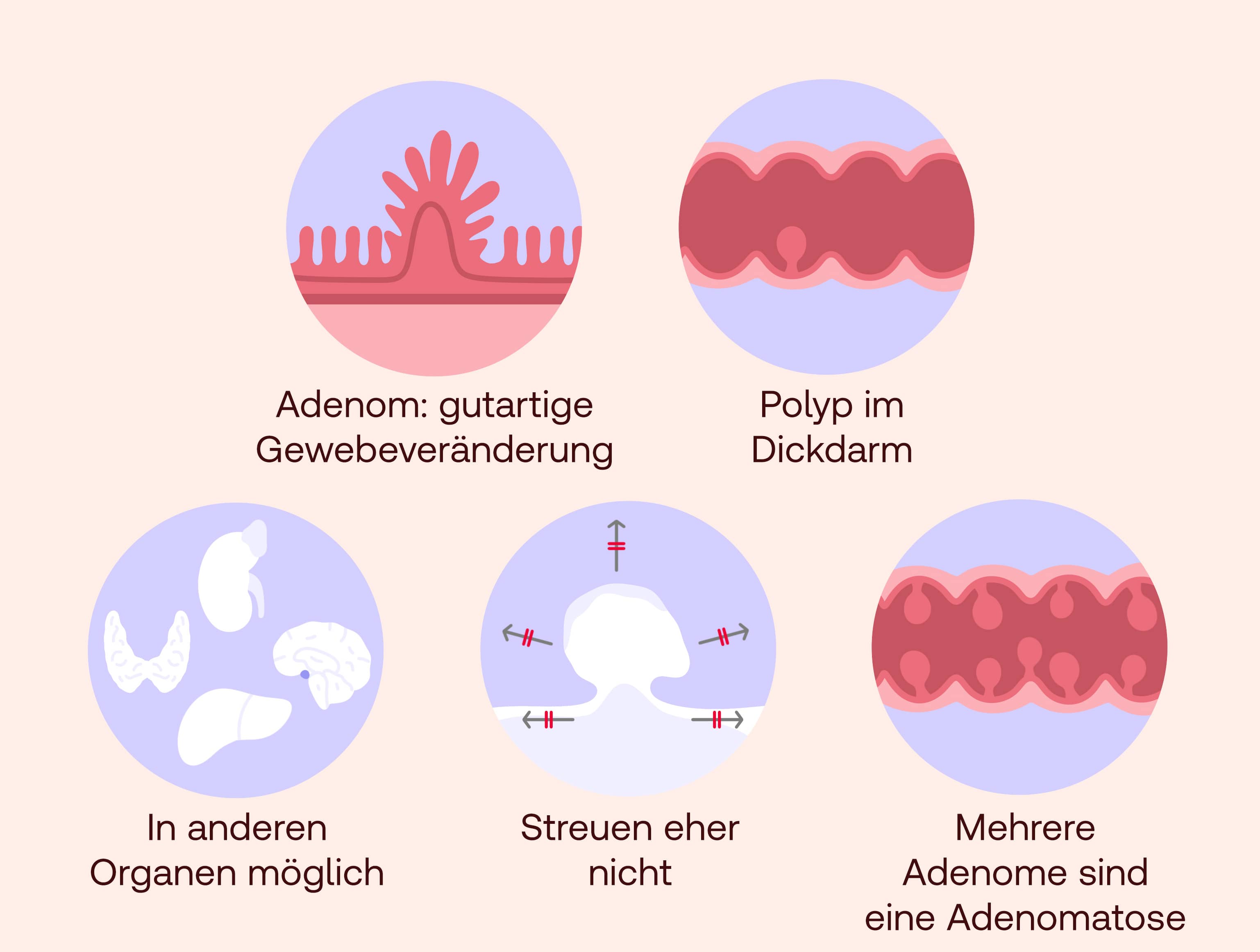 was ist ein adenom