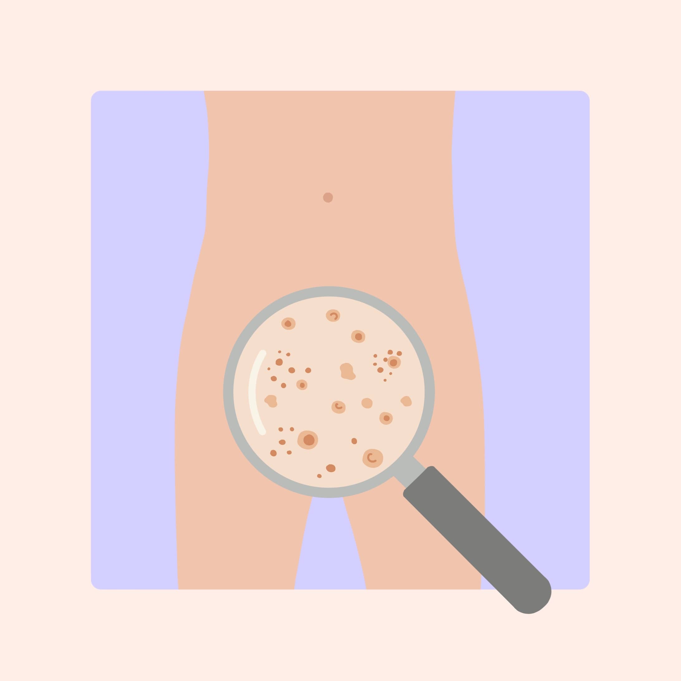 Wie sehen Feigwarzen aus?