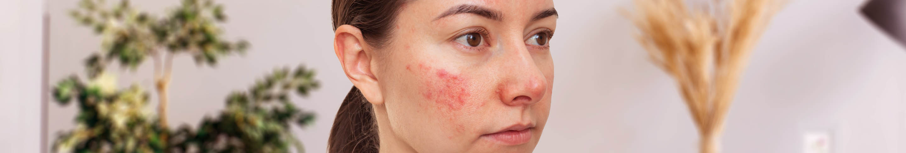 Rosacea Ratgeber