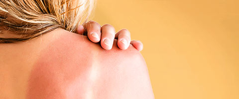 Sonnenbrand – die Verbrennungen der Haut schnell behandeln