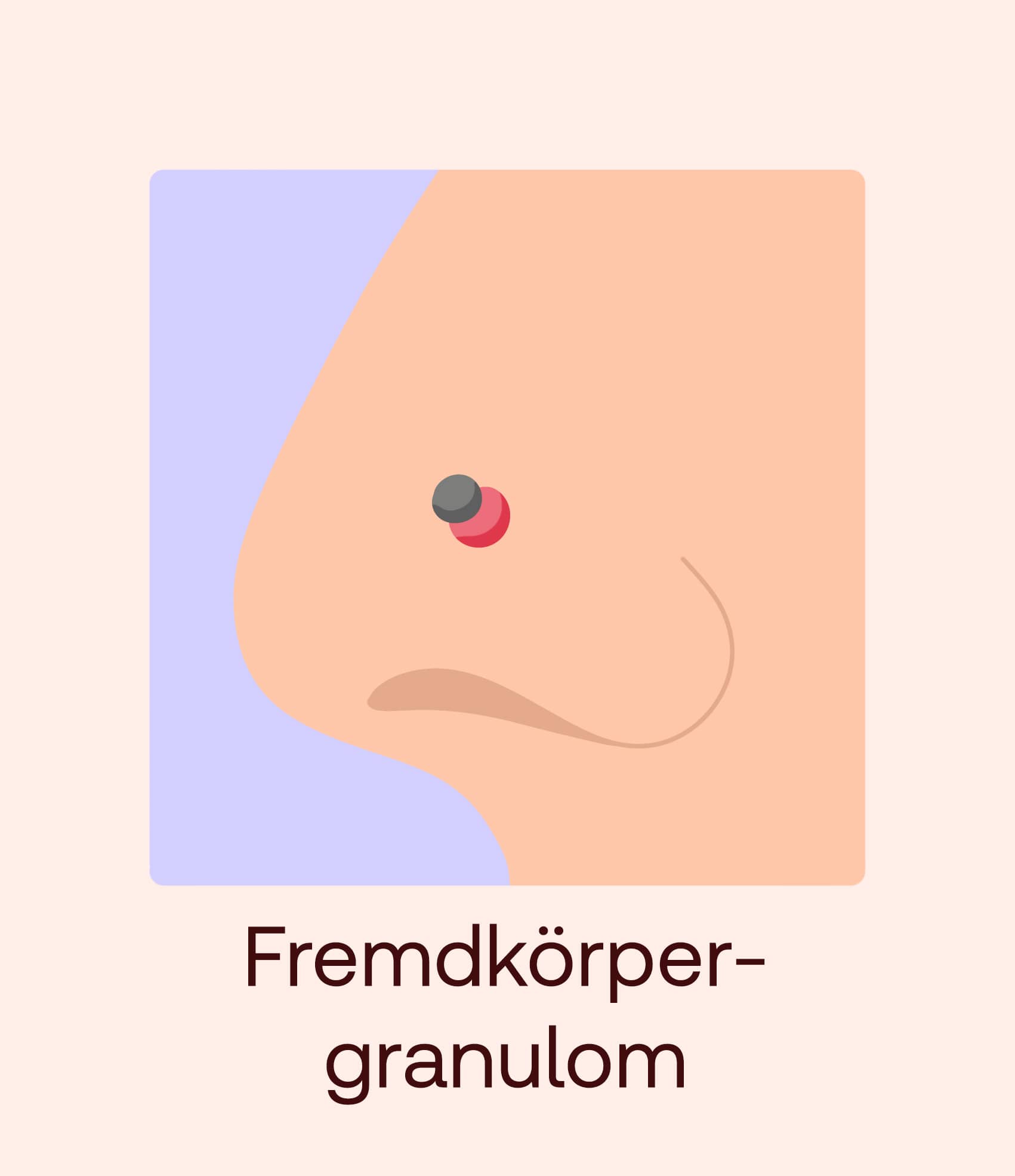 fremdkörpergranulom