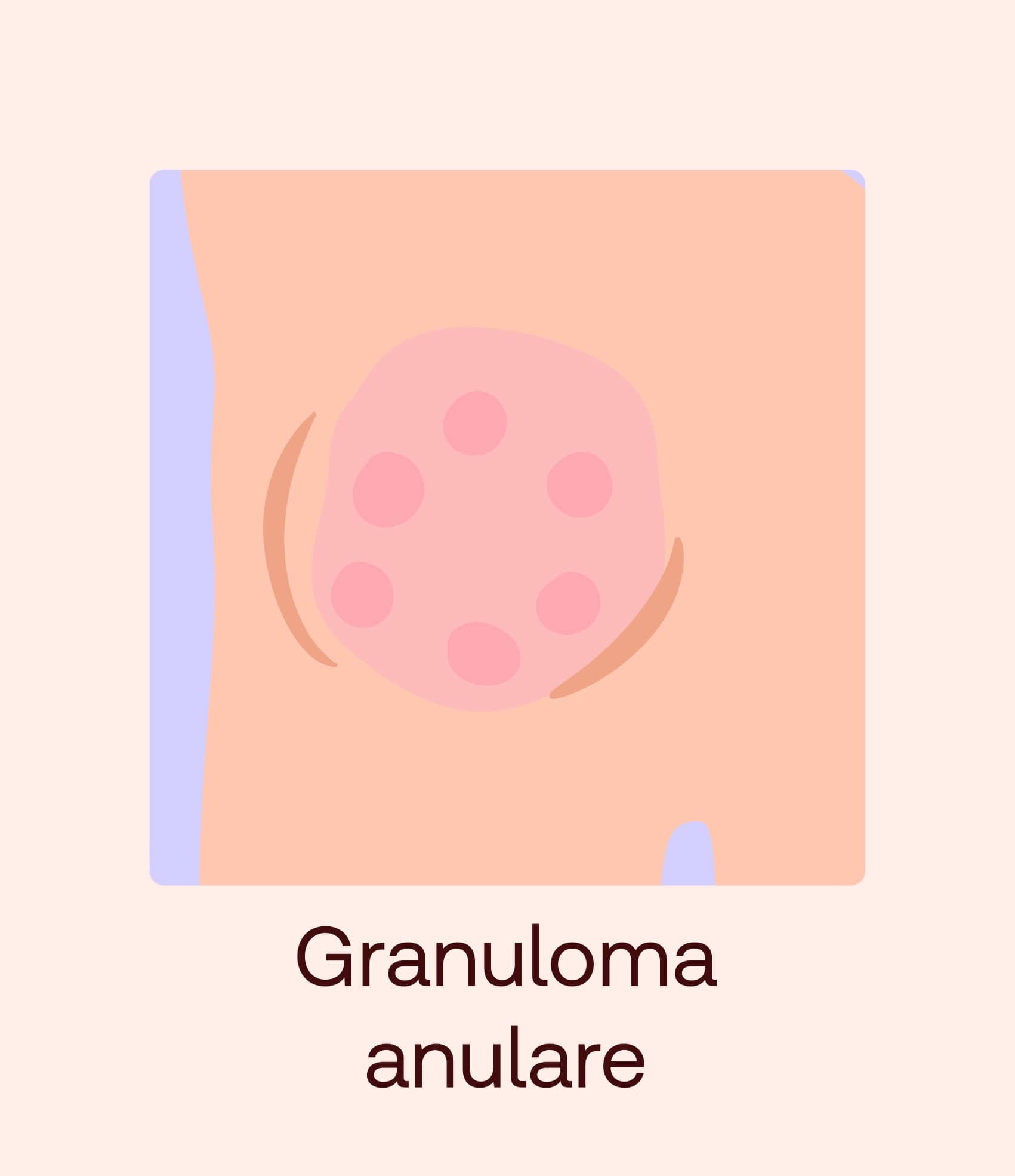granuloma anulare
