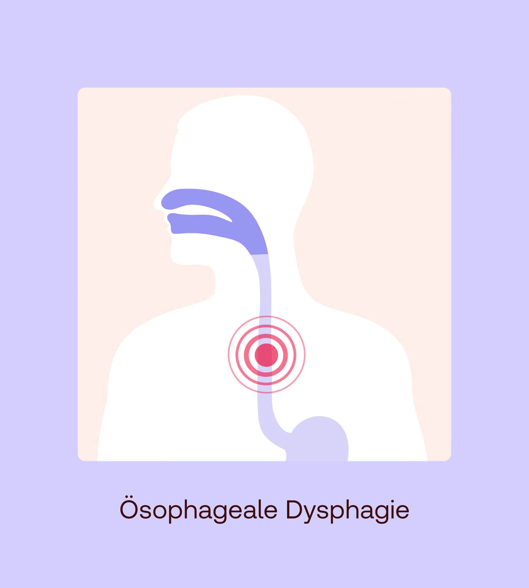 Ösophageale dysphagie