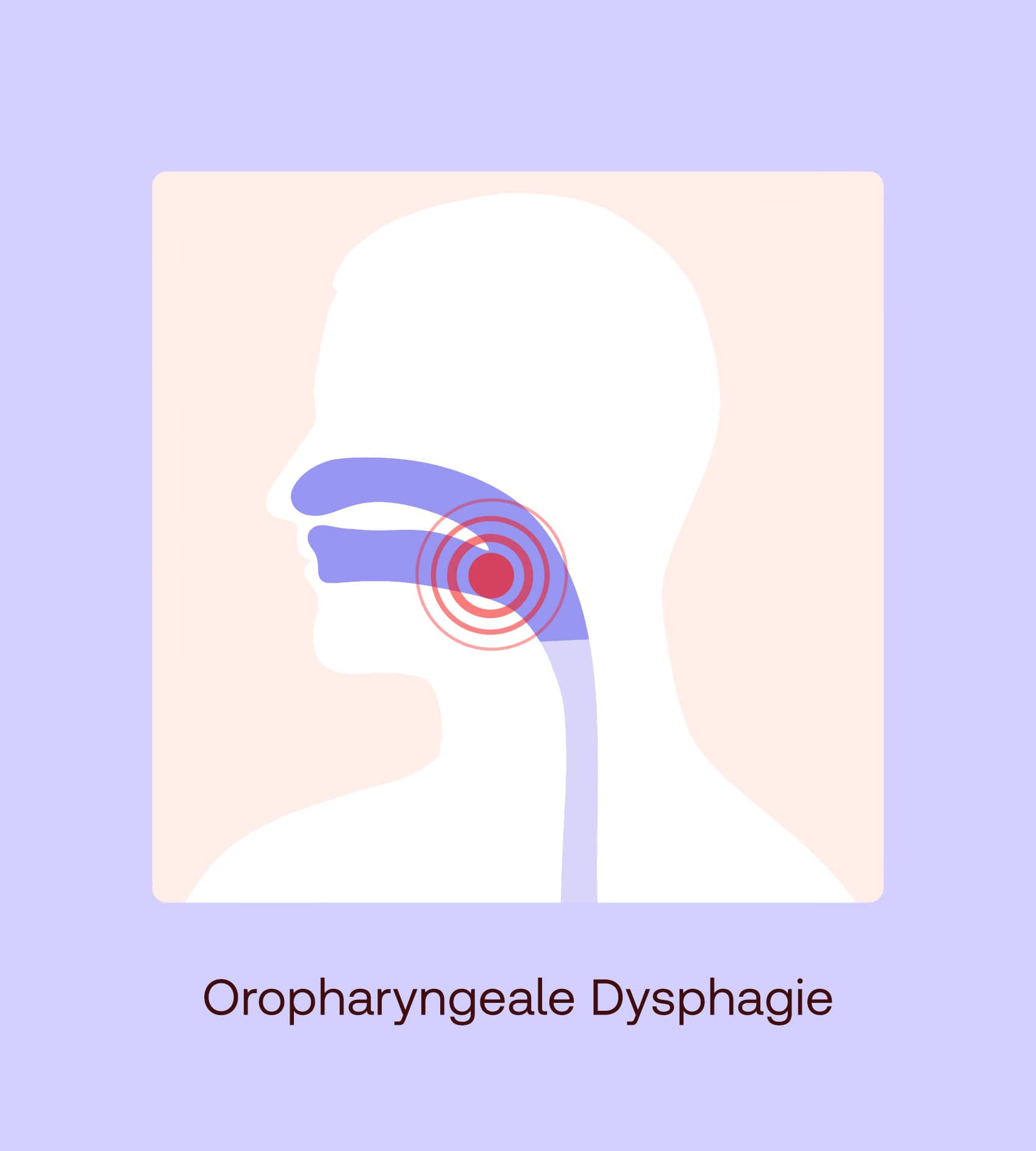 oropharyngeale dysphagie