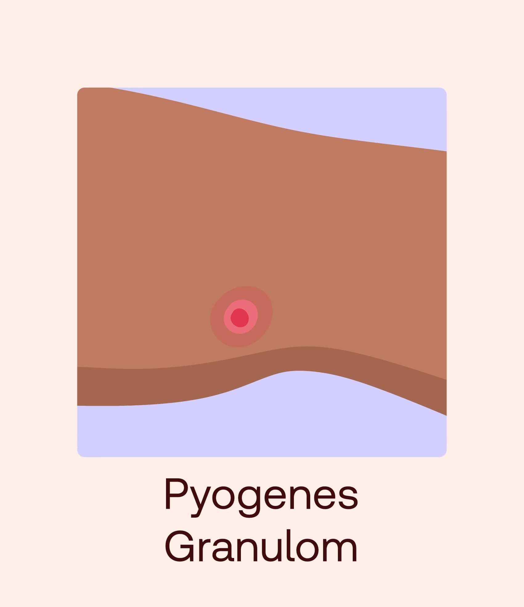 pyogenes granulom