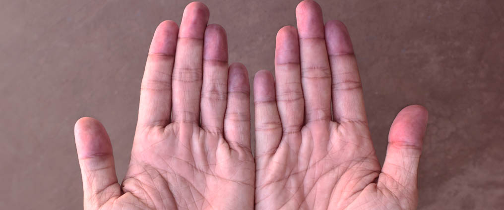 Blaue Lippen und Finger - Ursache und Behandlung