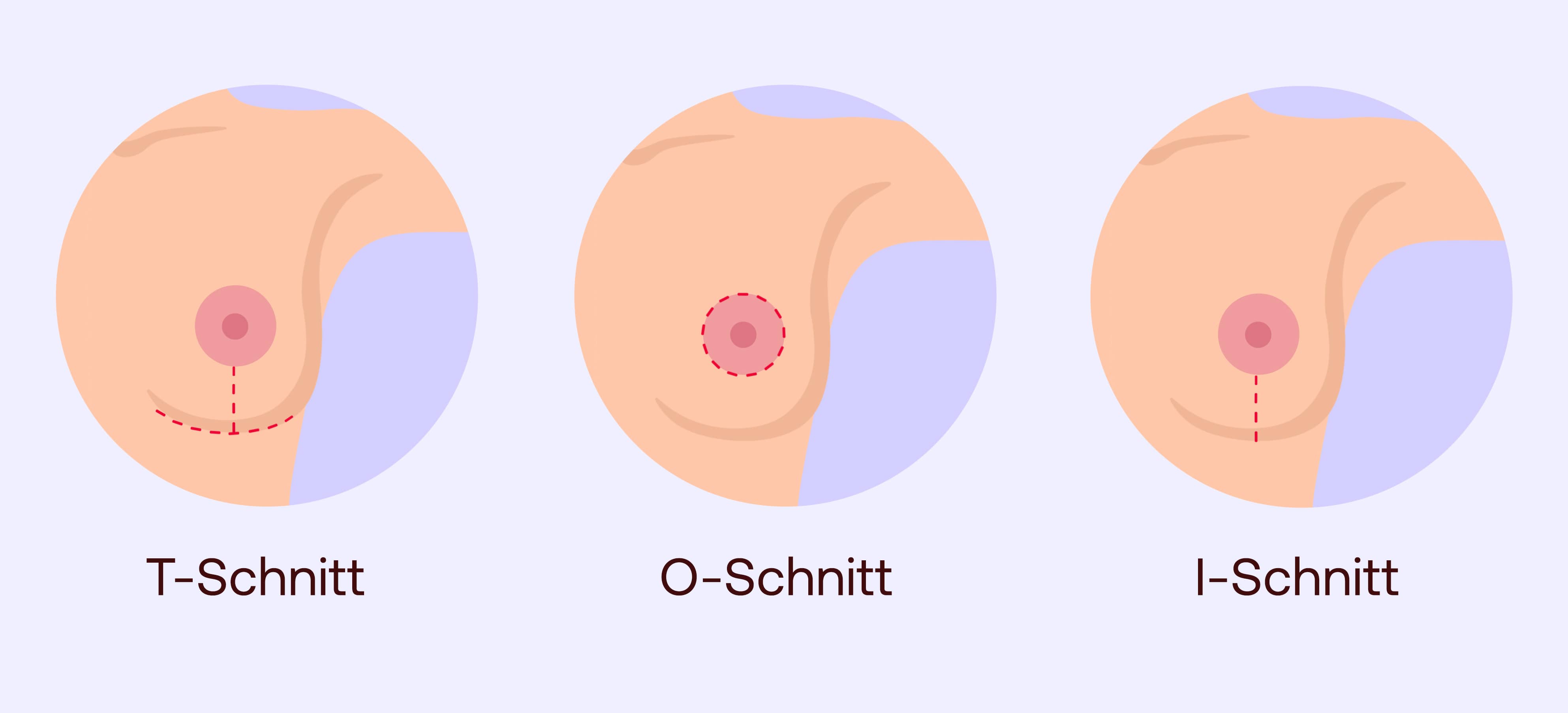 Bruststraffung