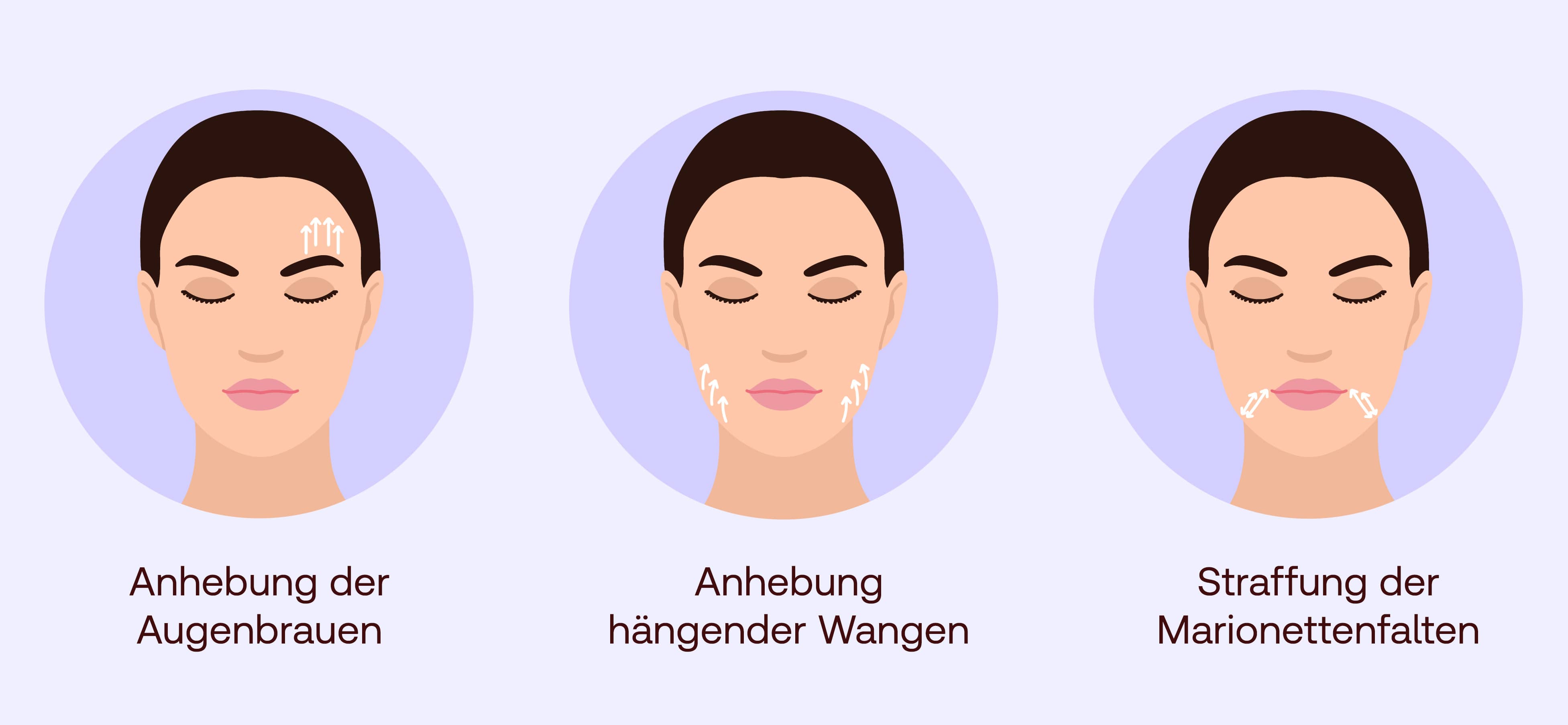 Fadenlifting Anwendungsbereiche