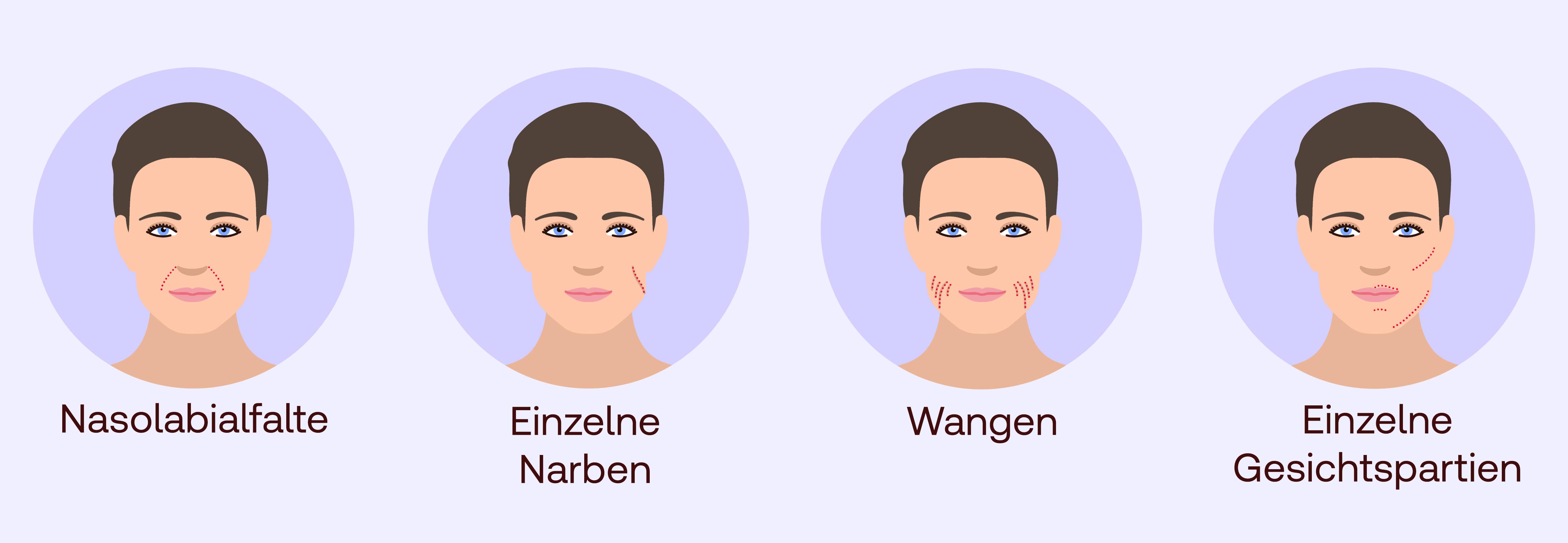 Faltenunterspritzung Anwendungsbereiche