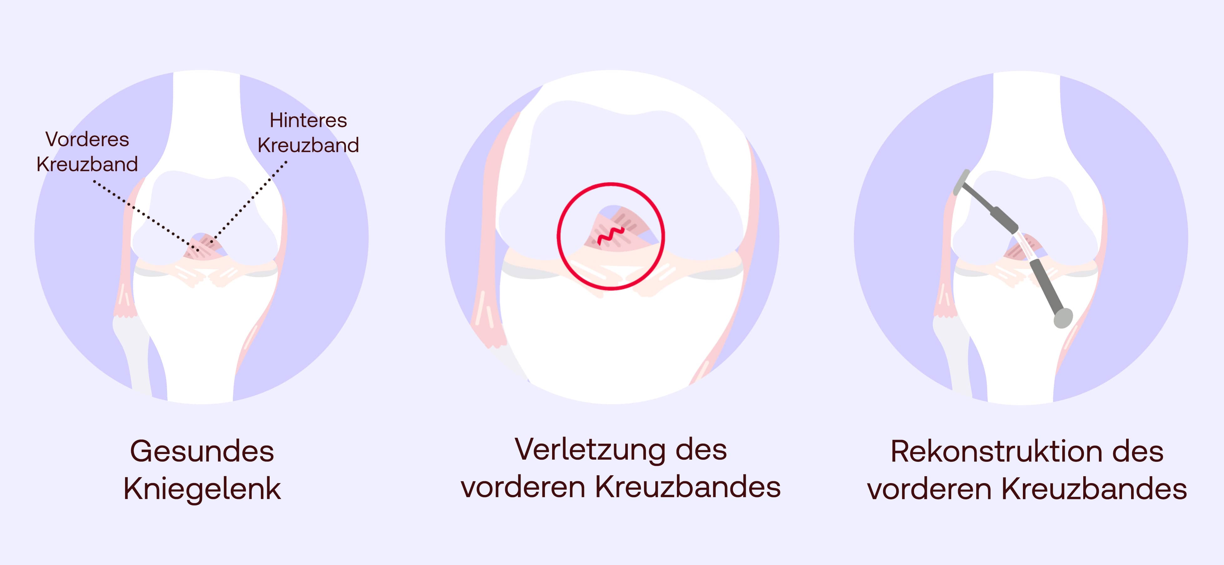 Kreuzband Op