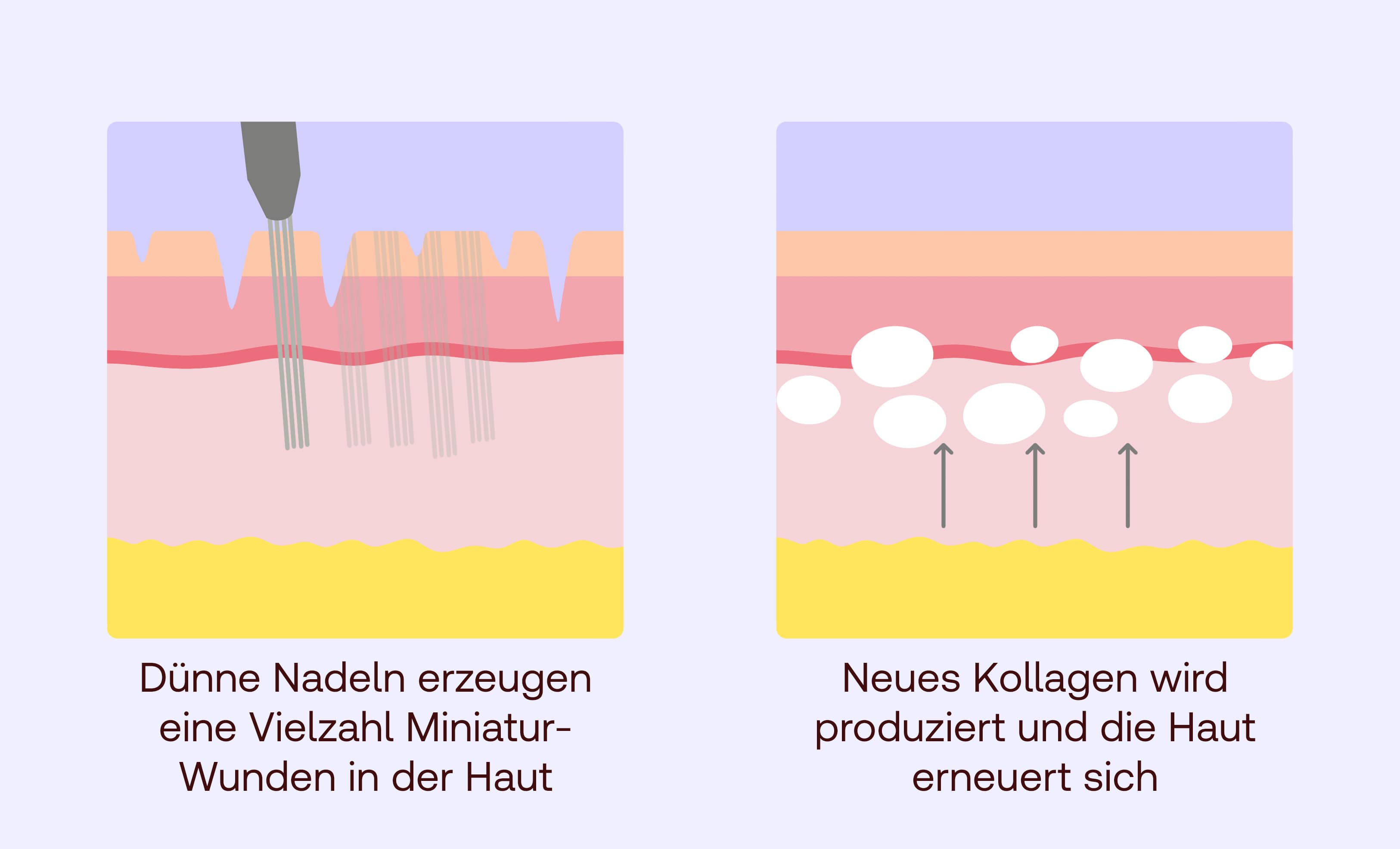 Microneedling
