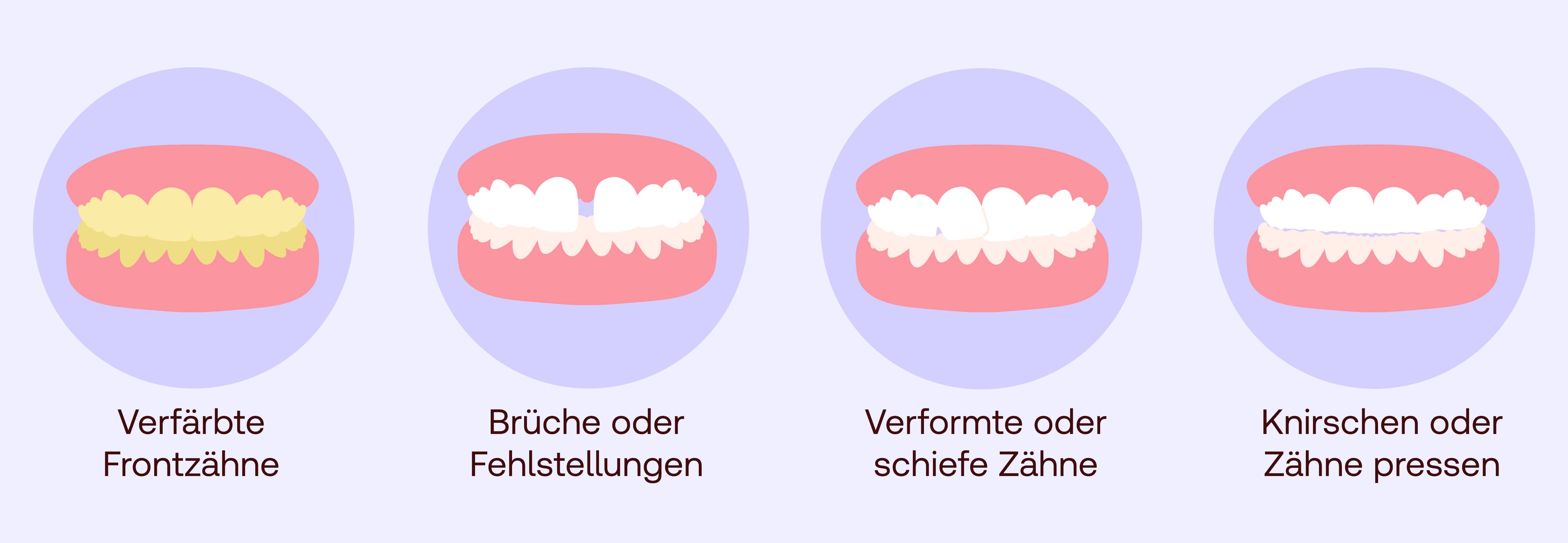 Veneers Anwendungsbereiche
